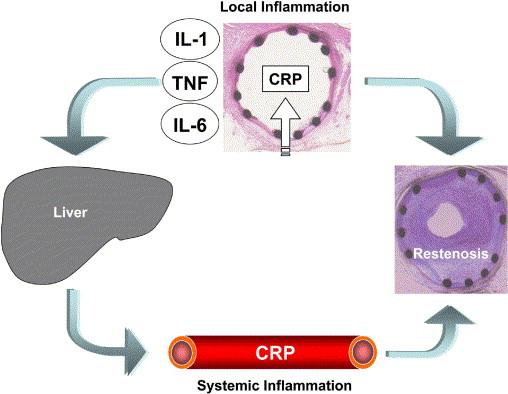 Figure 1.10. Interaction of local (cytokine release) and systemic (CRP production) inflammatory responses in the onset of restenosis. Figure from Gaspardone, et al. (2005)[77].