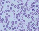 CBC diagnostic case study Figure 4 Figures 5 and 6: Note the large immature erythrocytes that are now present: these larger erythrocytes are represented by the additional curve on the right of the