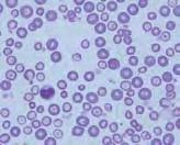 Microcytosis occurs supposedly because erythrocyte precursors continue to divide in an attempt to reach their full hemoglobin content. Additional divisions result in smaller than normal erythrocytes.