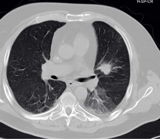 pulmonary tumor with surrounding vessels.