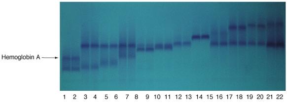 electrophoresis Non-denatured proteins are placed in a polyacrylamide gel, which is subjected to an electrical current Proteins