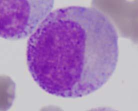 Classification of Immature Granulocytes Metamyelocytes, Myelocytes,