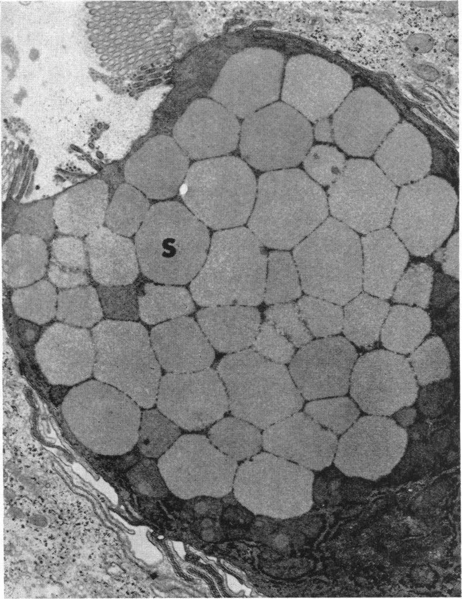 Variable amounts of heterogeneous material, presumably consisting of mucus and cellular debris, were noted on the surface epithelium of some villi (Fig. 1) and in the lumina of some crypts.