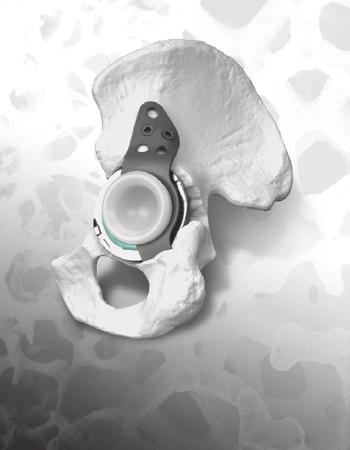 Trabecular Metal Acetabular Revision System Cup-Cage