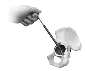 Trabecular Metal Acetabular Revision System Cup-Cage Construct Prepare Ischial Notch for Inferior Flange Palpate the posterior rim of the acetabulum from superior to inferior to identify the ischium.