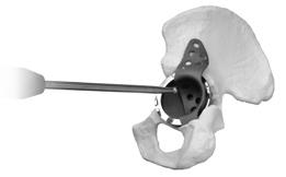 Trabecular Metal Acetabular Revision System Cup-Cage Construct WARNING: Avoid reverse or repeated bending of the titanium implant as this may weaken or break the flange.