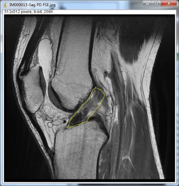 ACL Tear Imaging