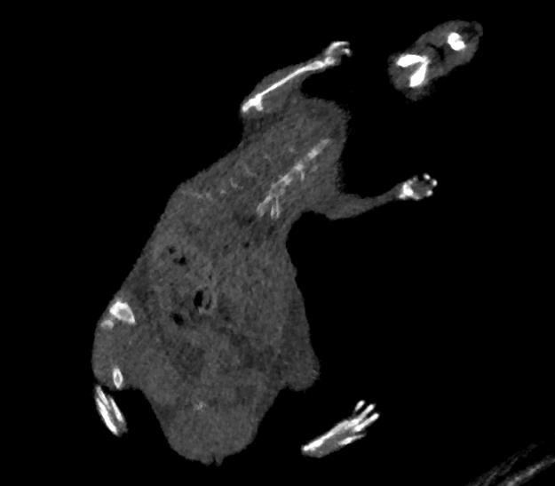 Reminder: Low contrast limit of conventional medical CT Low tissue contrast Axial CT