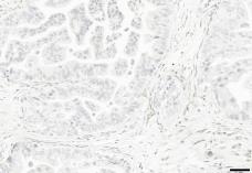 (c) Antigen retrieval with rodent decloaker plus fast enzyme followed by anti-her2/4b5 receptor staining showed no specific HER2 receptor coloring.