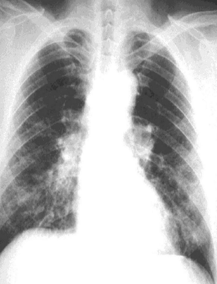 Asbestos exposure can lead to serious health effects that cause death, including: Chronic lung disease