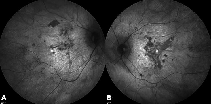 Leisy et al. 674 CASE CLINICAL REPORT IMAGES PEER REVIEWED OPEN ACCESS Severe Stargardt disease with peripapillary sparing Heather Leisy, Meleha Ahmad, Nathaniel Tracer, R.