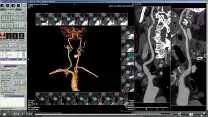 Vital Post-Processing Tools Vitrea software enables the visualization and analysis of 2D, 3D and 4D images of anatomy and physiological functions using CT (computed tomography) and MR (magnetic