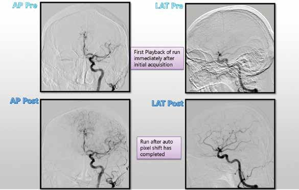 Conventional Imaging in Neuro Intervention Digital Subtraction Angiography (DSA) Standard neuro angiographic