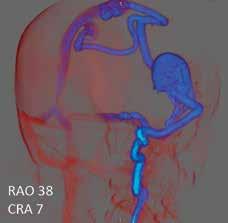 The 3D vessel can be rotated in any direction to provide clinicians with additional views of vascular anatomy to aid them in their