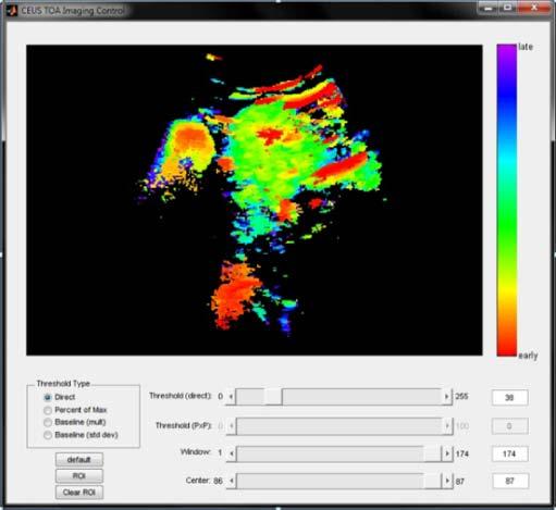 Casey Ta - CRIN Research Plan Compressing the Time Element of Contrast Enhanced Ultrasound into a Single Image for Tumor Diagnosis Mentors: Dr. Robert Mattrey (Radiology) and Dr.