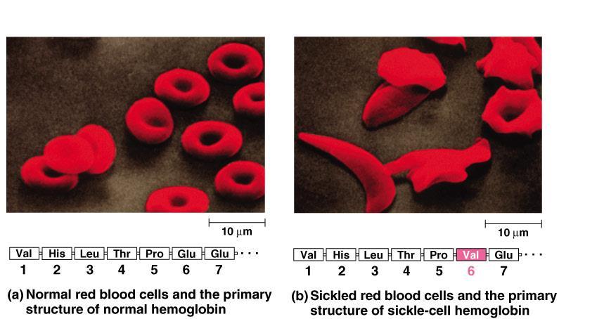 Sickle cell anemia Hemoglobin