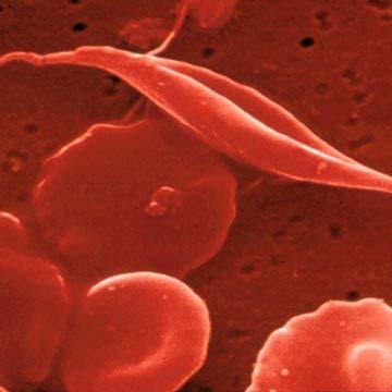 Srpastocelična anemija Kavkaška populacija = MUTACIJA (HBB gen za β-globin, točkasta