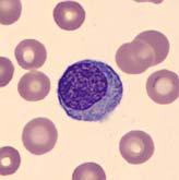 Case Study - Clinical History 75 year old female diagnosed with monoclonal gammopathy of uncertain