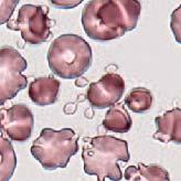 Possible interferences RBC fragments counted as platelets: falsely high Microcytic RBCs counted as