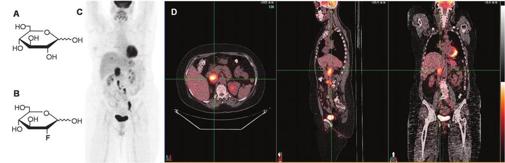 Fig. 1 (A) D-Glucose, (B) 18 F-FDG, (C) an 18 F-FDG PET image and (D) a PET/CT image of a patient with a paradudodenal mass secondary to malignant melanoma.