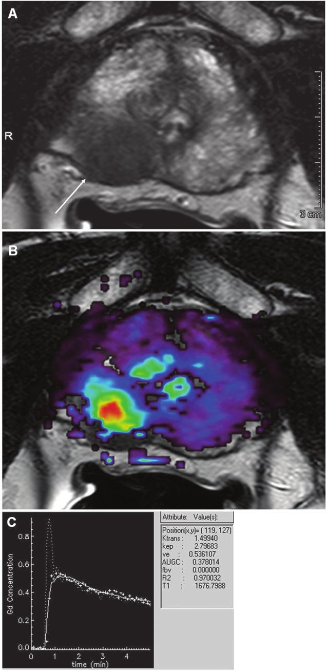 Dynamic contrast enhanced MRI. Dynamic contrast enhanced (DCE) MRI is the serial imaging of a patient, before, during, and after contrast administration.