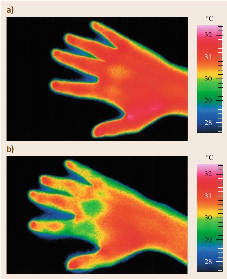 Biothermal Signals: Thermography The Most important biothermal signal is the body temperature Using thermography, temperature distribution on a skin