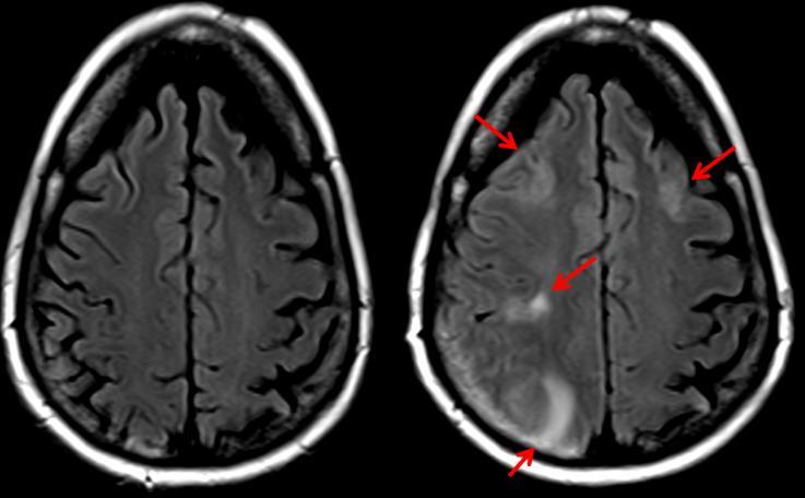 MRI Safety Biomarkers Amyloid Related Imaging Abnormalities (ARIA) ARIA with vasogenic edema (ARIA-E) straight-forward to diagnose Rare event (incidence rate AD ~0.