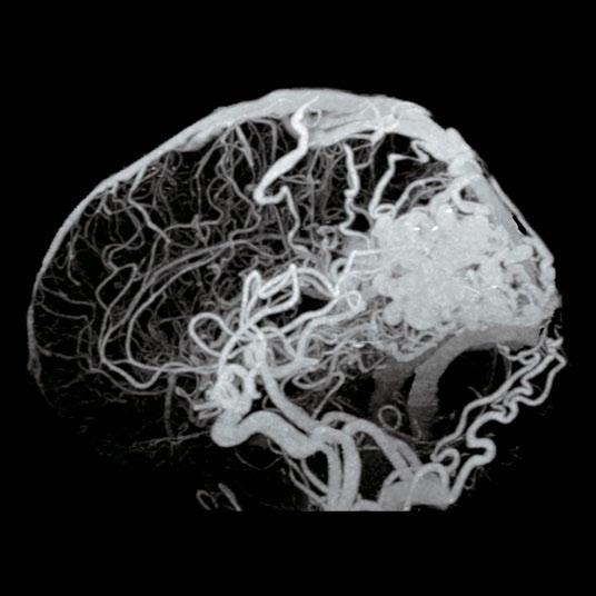 Temporal and parietal lobe