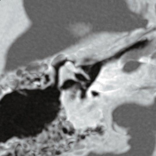 Mandibular bone cyst seen in