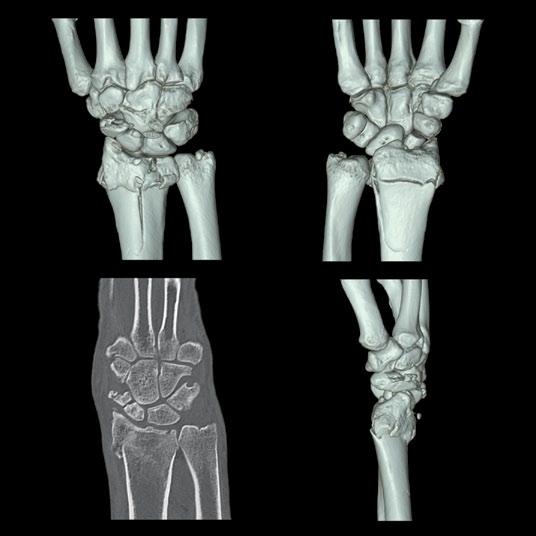 Complex fracture of the