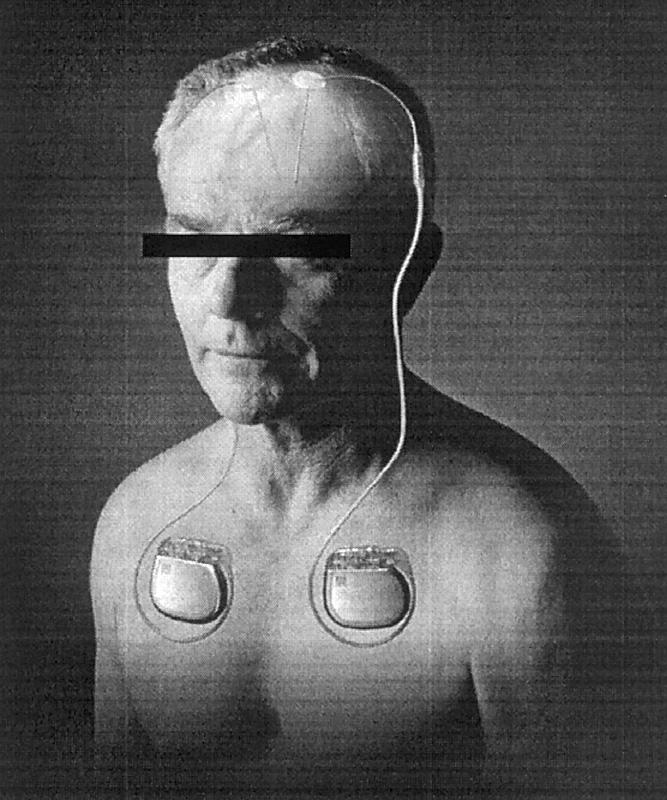 492 Shellock Figure 3. The Activa Tremor Control System showing the Soletra Model 7426 neurostimulator, Model 7495 quadripolar extension, and Model 3389 DBS lead.
