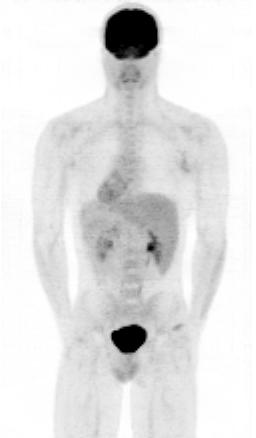 p.i. ECAT ACCEL 50 year-old male with colon CA 91 kg, 183 cm, 720 MBq FDG, 162 min p.i. Emission scan
