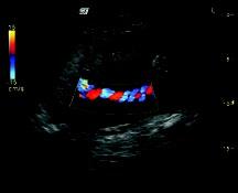 carotid artery with Spectral