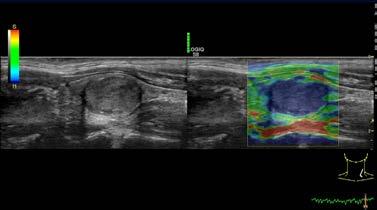 COMPARE ASSISTANT Clinicians can easily view a prior ultrasound, mammography, CT or MR image and current images together in real