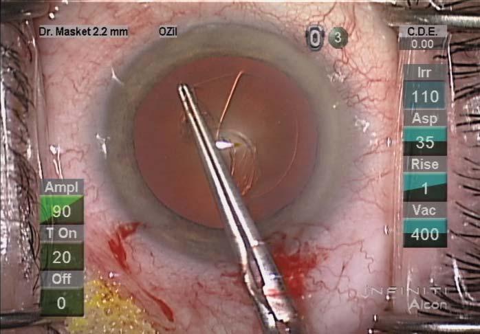 0-mm nearly square clear corneal incision. No patient had an IOP less than 10 mm Hg, and there was no evidence of hypotony or wound leakage by Seidel testing in either group.