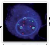 (karyotyping) Myeloma Cell