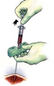 Step 4: Advance Needle Using gentle but firm pressure, advance the needle, rotating it in an alternating