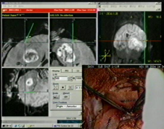 Surgical Navigation Realtime-updated Navigation System with intraoperative MRI can improve removal rate of malignant