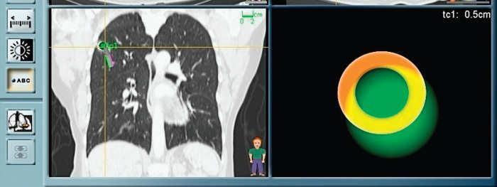 real-time bronchoscopy to CT