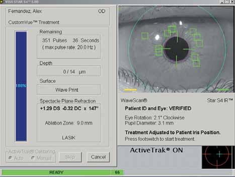 Studies have shown that cyclotorsional misalignment as the result of improper registration of the intended ablation shape with the cornea during a wavefront procedure can induce significant RMS error