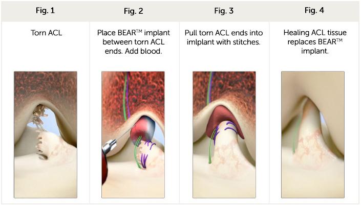1 st EFS Device to Pivotal Trial Bridge-Enhanced(TM) ACL Repair Experimental use of a bridging scaffold to repair the ACL Potential benefit: No need to harvest a tendon, addresses clinical need