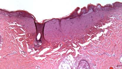 Imaging of of Skin Burn in in Pigs Acute thermal (175 o