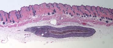 Melanoma B-scan image at 764 nm Melanoma Histology 1 mm