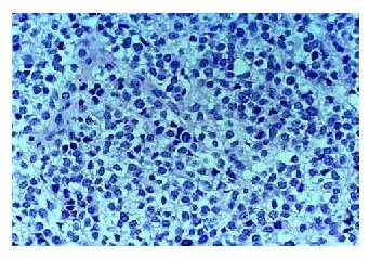 Small Round Blue Cell Tumors Recent work by Khan et al has used microarrays to diagnose four types of pediatric tumors, Small Round Blue Cell Tumors (SRBCT): neuroblastoma Ewing family tumors