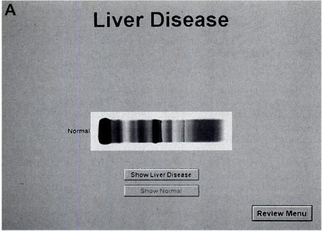 Fig. 4. First (A) and last (B) screen from an animation sequence in the Review of Disease States section that shows transformation from a normal pattern to a liver disease pattern.