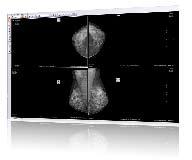 PowerServer PACS Digital Mammography The PowerServer PACS allows you to read digital mammography quickly and efficiently from any web-based PowerReader clinical workstation.