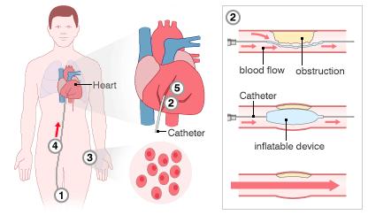 spontaneously to form endothelial and smooth muscles. Here a catheter is inserted into a blood vessel, and then an inflated device is used to widen the blocked coronary artery (Figure-2).