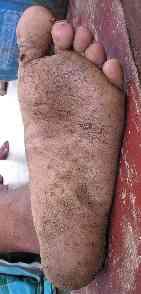 Nodules and Cracks over Thickened So Agin Singh Diffuse varicose lesions
