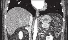 Abdominal FBP Compared to FBP, this Veo image illustrates: Significant reduction in