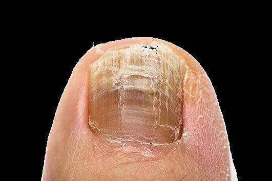 Global onychomycosis market US$3.06 billion in 2015 and projected to reach US$4.7 billion by 2021.